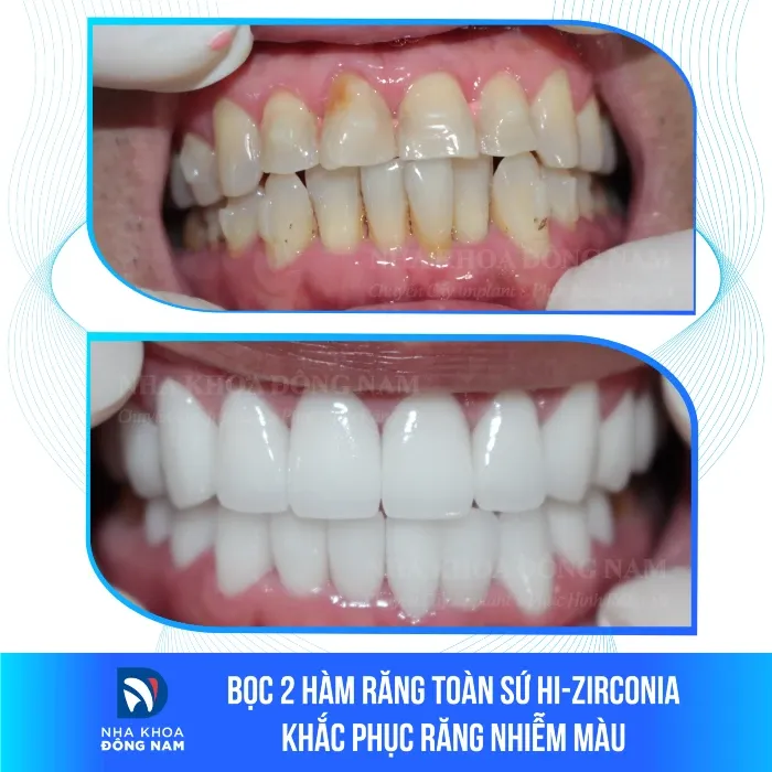 Sản phẩm boc 2 ham rang toan su hi zirconia khac phuc rang nhiem mau — Nha Khoa Đông Nam — MST 0304132304