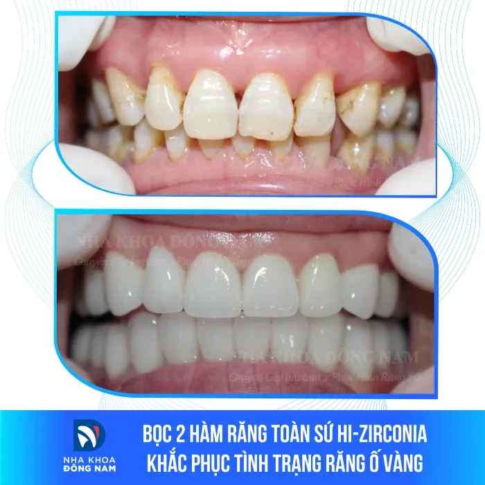 Sản phẩm boc 2 ham rang toan su hi zirconia khac phuc tinh trang rang o vang — Nha Khoa Đông Nam — MST 0304132304