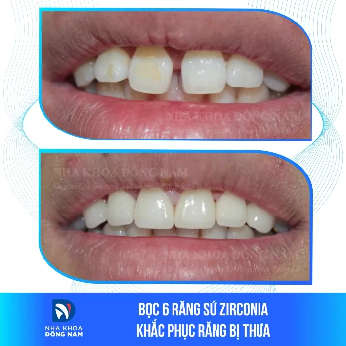 Sản phẩm boc 6 rang su zirconia khac phuc rang bi thua — Nha Khoa Đông Nam — MST 0304132304