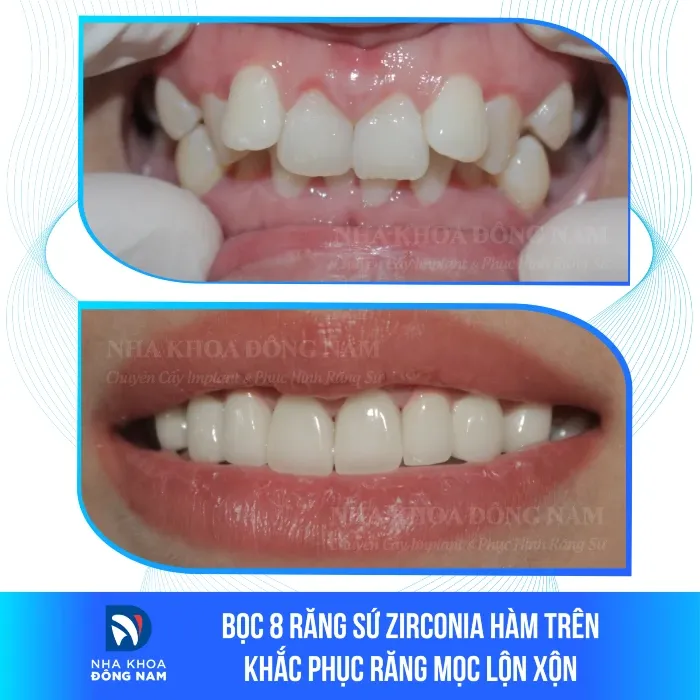 Sản phẩm boc 8 rang su zirconia ham tren khac phuc rang moc lon xon — Nha Khoa Đông Nam — MST 0304132304