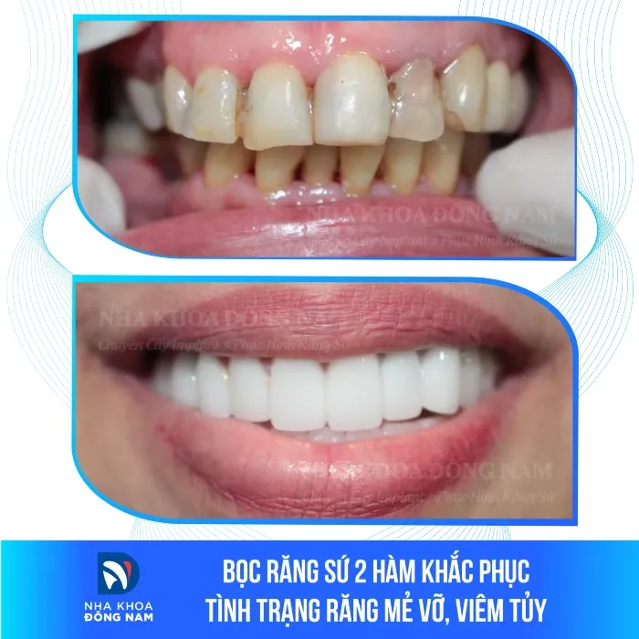 Sản phẩm boc rang su 2 ham khac phuc tinh trang rang me vo viem tuy — Nha Khoa Đông Nam — MST 0304132304