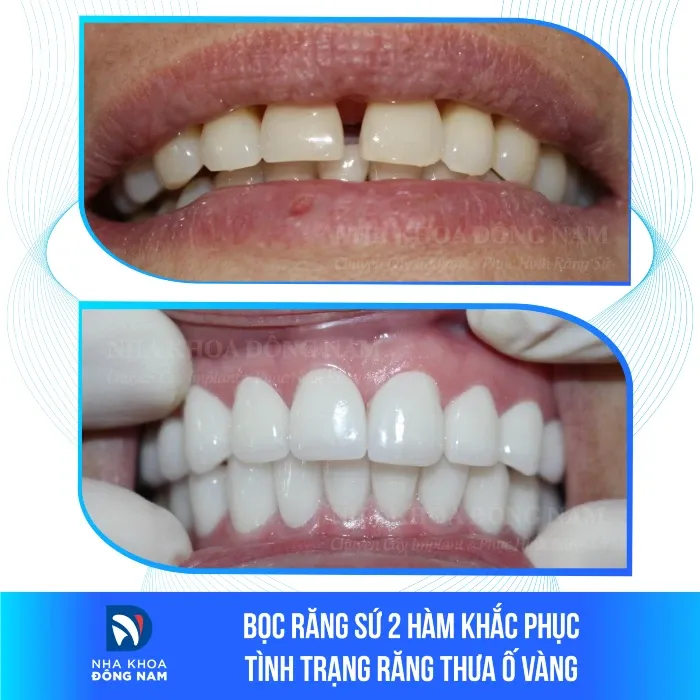 Sản phẩm boc rang su 2 ham khac phuc tinh trang rang thua o vang — Nha Khoa Đông Nam — MST 0304132304