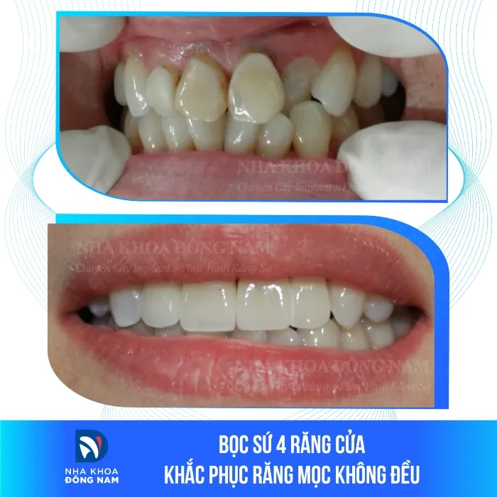 Sản phẩm boc su 4 rang cua khac phuc rang moc khong deu — Nha Khoa Đông Nam — MST 0304132304