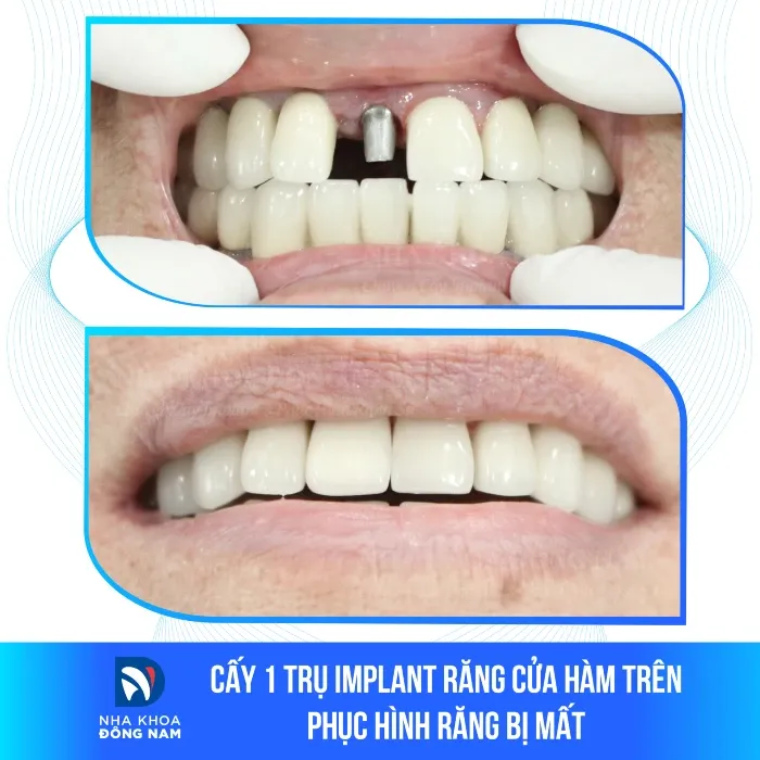 Sản phẩm cay 1 tru implant rang cua ham tren phuc hinh rang bi mat — Nha Khoa Đông Nam — MST 0304132304