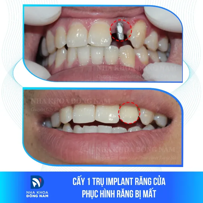 Sản phẩm cay 1 tru implant rang cua phuc hinh rang bi mat — Nha Khoa Đông Nam — MST 0304132304