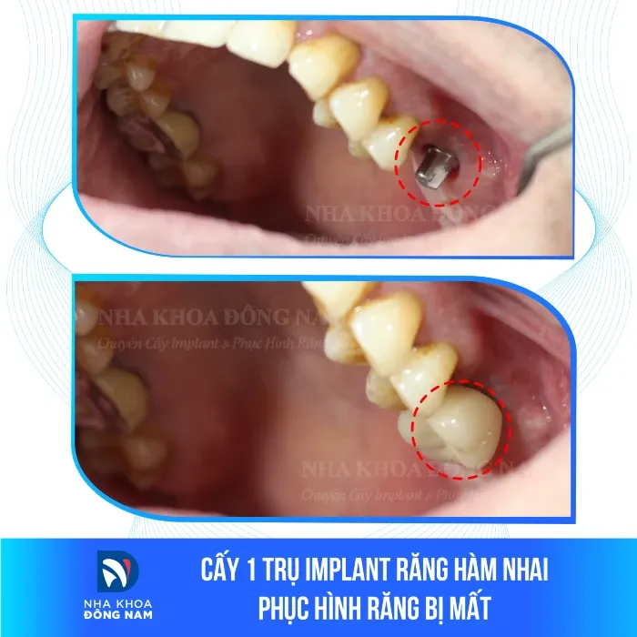 Sản phẩm cay 1 tru implant rang ham nhai phuc hinh rang bi mat — Nha Khoa Đông Nam — MST 0304132304