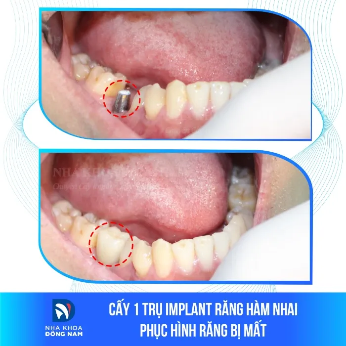 Sản phẩm cay 1 tru implant rang ham nhai so 6 phuc hinh rang bi mat — Nha Khoa Đông Nam — MST 0304132304