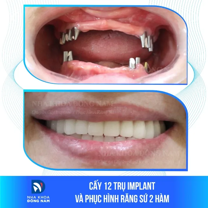 Sản phẩm cay 12 tru implant va phuc hinh rang su 2 ham — Nha Khoa Đông Nam — MST 0304132304