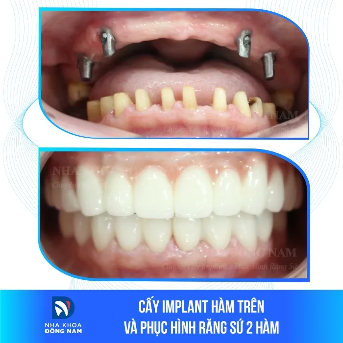 Sản phẩm cay implant ham tren va phuc hinh rang su 2 ham — Nha Khoa Đông Nam — MST 0304132304
