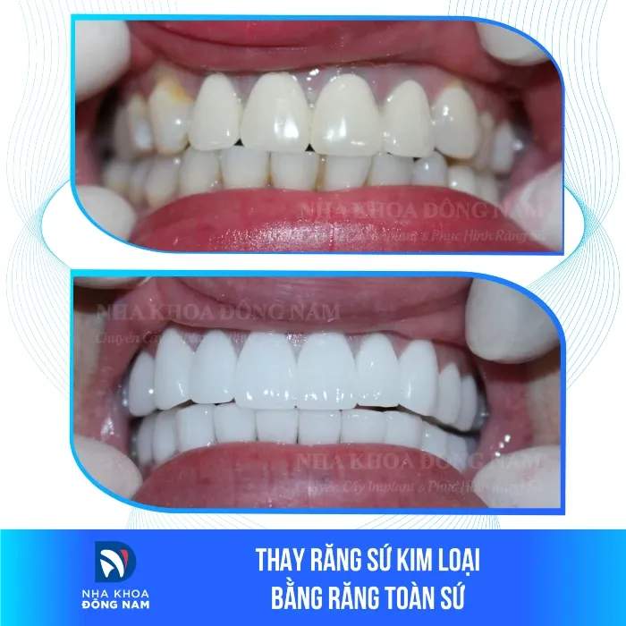 Sản phẩm thay rang su kim loai bang rang toan su — Nha Khoa Đông Nam — MST 0304132304