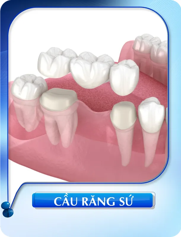 Sản phẩm cau rang su — Nha Khoa Đông Nam — MST 0304132304