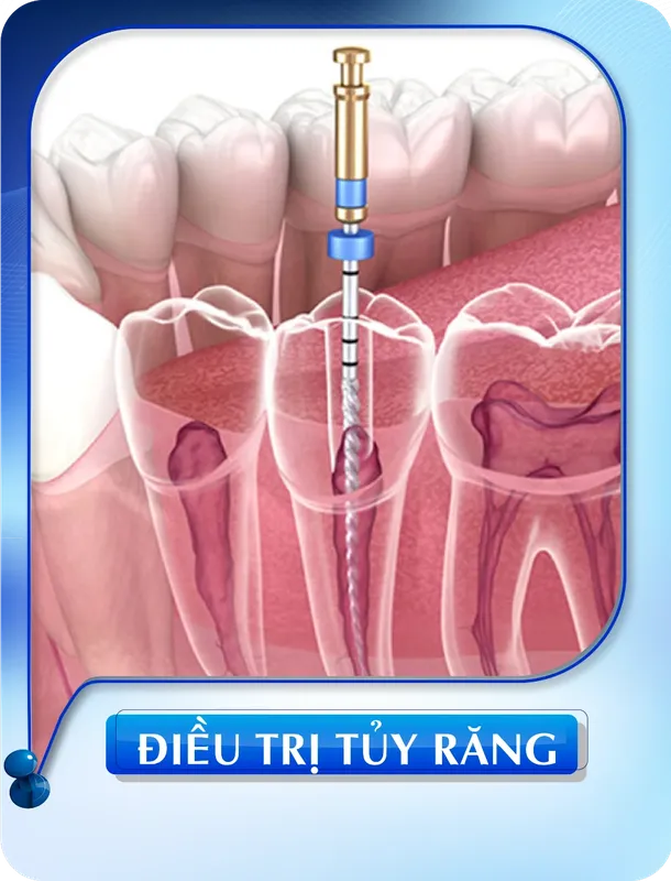 Sản phẩm dieu tri tuy rang 1 — Nha Khoa Đông Nam — MST 0304132304