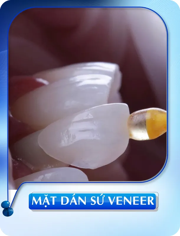 Sản phẩm mat dan su veneer — Nha Khoa Đông Nam — MST 0304132304
