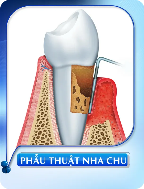 Sản phẩm phau thuat nha chu — Nha Khoa Đông Nam — MST 0304132304