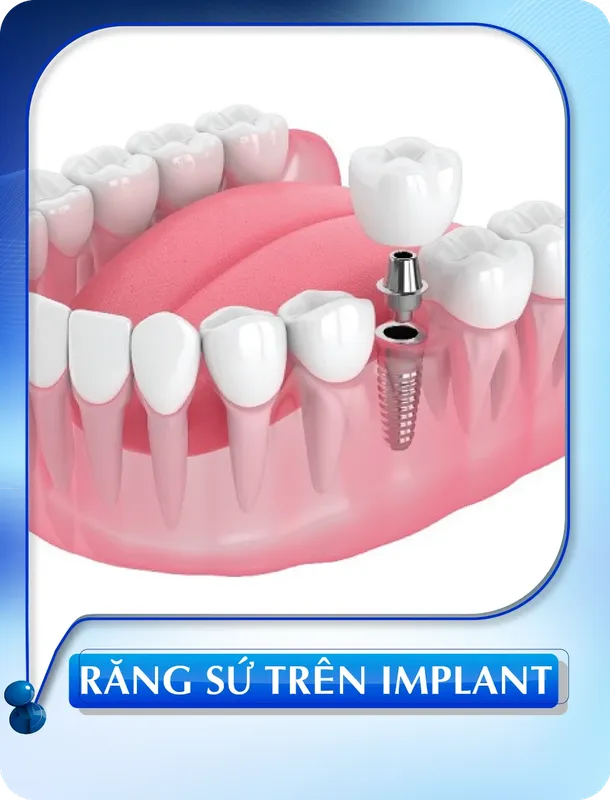 Sản phẩm rang su tren implant — Nha Khoa Đông Nam — MST 0304132304