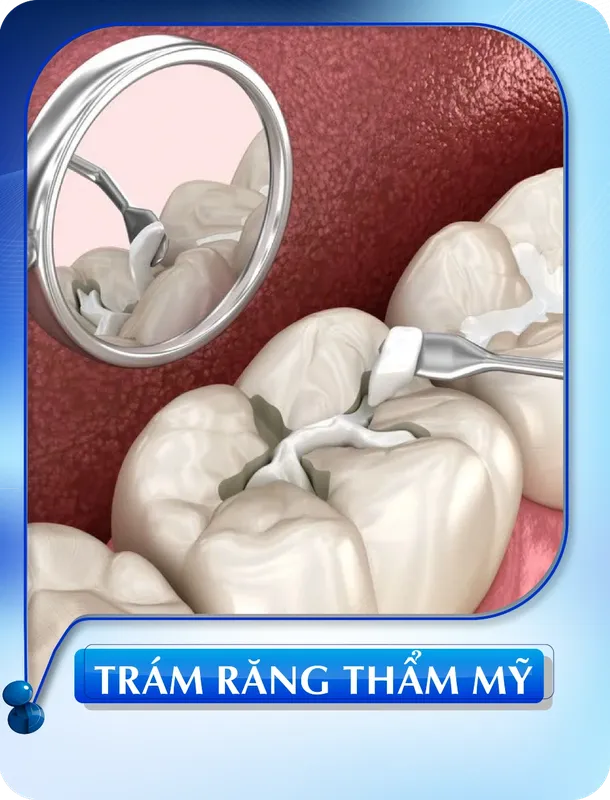 Sản phẩm tram rang tham my 1 — Nha Khoa Đông Nam — MST 0304132304