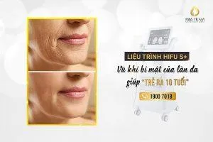 Sản phẩm bang gia tre hoa da khong phau thuat hcm 300x200 — Trung Tâm Thẩm Mỹ Miss Trâm — MST 0305993715