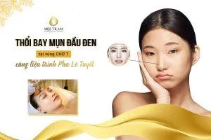 Sản phẩm dich vu dieu tri mun dau den hieu qua hcm 300x200 — Trung Tâm Thẩm Mỹ Miss Trâm — MST 0305993715