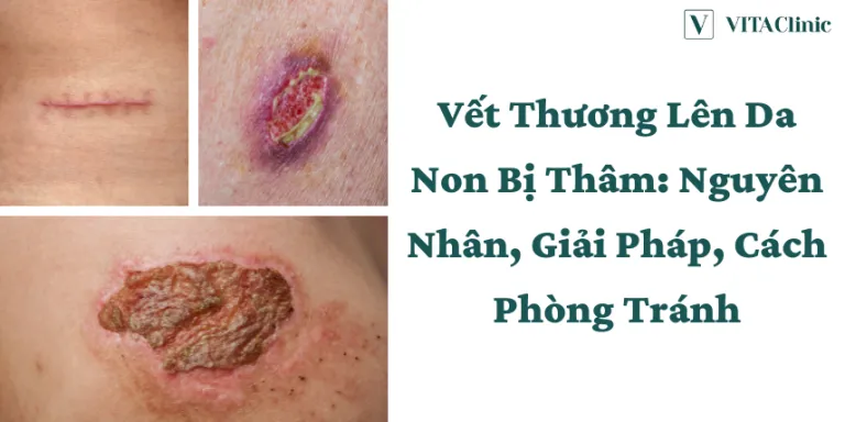 Sản phẩm vet thuong bi tham den lam sao het 1 768x384 — Công Ty TNHH Halo Group — MST 0309188244