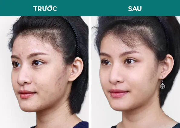 Sản phẩm before after tri mun — Thẩm Mỹ Diamond — MST 0309944010