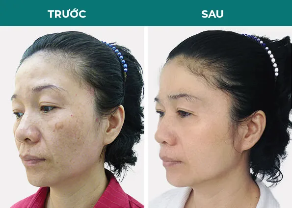 Sản phẩm before after tri tan nhang — Thẩm Mỹ Diamond — MST 0309944010