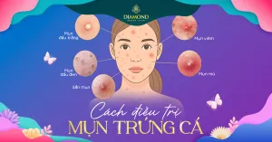 Sản phẩm 5 cach tri mun trung ca tai nha an toan va hieu qua 300x157 — Thẩm Mỹ Diamond — MST 0309944010