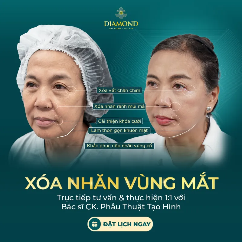 Sản phẩm Xoa nhan vung mat — Thẩm Mỹ Diamond — MST 0309944010