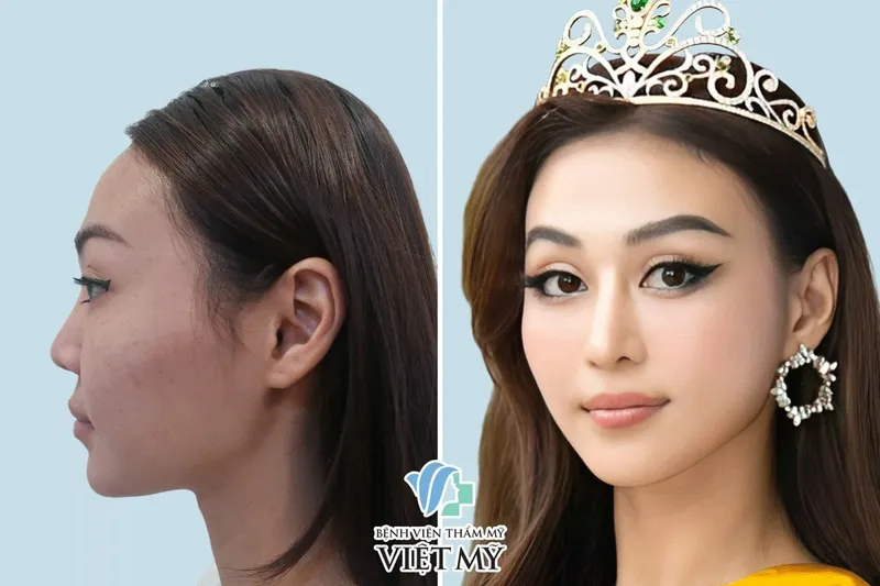 Sản phẩm A hau Tuyet Nhu nang mui tai Benh vien tham my Viet My — Công Ty TNHH Bệnh Viện Thẩm Mỹ Việt Mỹ — MST 0310494380