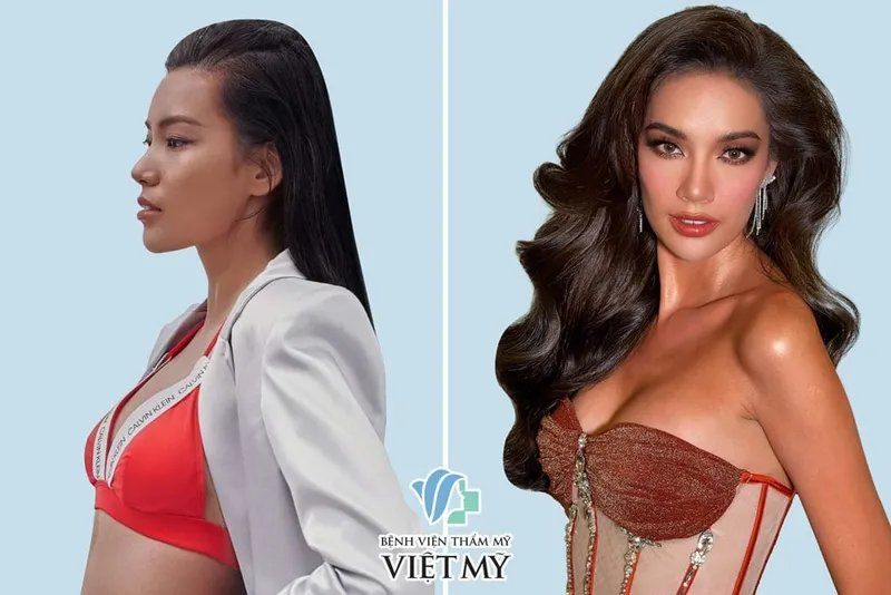 Sản phẩm hoa hau Le Hoang Phuong nang nguc tai benh vien tham my Viet My — Công Ty TNHH Bệnh Viện Thẩm Mỹ Việt Mỹ — MST 0310494380