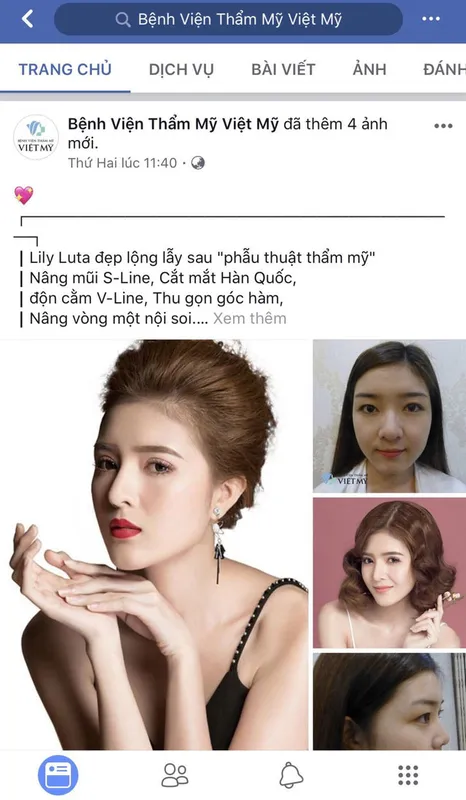 Sản phẩm lily luta hut mo bung — Công Ty TNHH Bệnh Viện Thẩm Mỹ Việt Mỹ — MST 0310494380