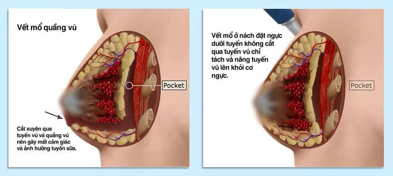 Sản phẩm Hinh anh dat tui nguc duoi tuyen duong nach va quang vu scaled — Công Ty TNHH Bệnh Viện Thẩm Mỹ Việt Mỹ — MST 0310494380