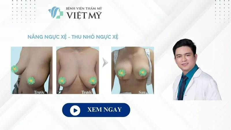 Sản phẩm Phau thuat nang nguc chay xe sau sinh Bac si Chiem Quoc Thai — Công Ty TNHH Bệnh Viện Thẩm Mỹ Việt Mỹ — MST 0310494380