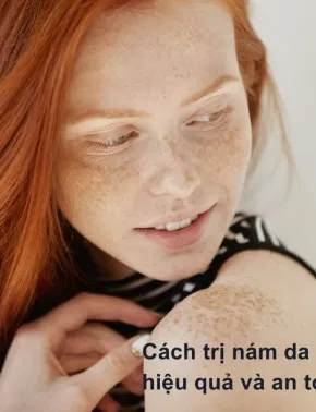 Sản phẩm cach tri na da mat lau nam 290x378 — Công Ty TNHH Một Thành Viên Paragon Premium Aesthetic Services — MST 0313459218