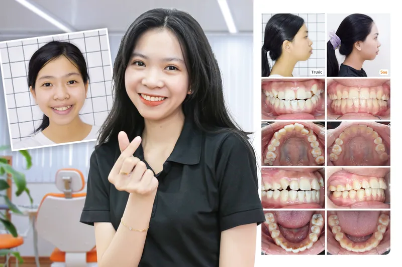 Sản phẩm bichhang — Công Ty CP Up Dental — MST 0313476125
