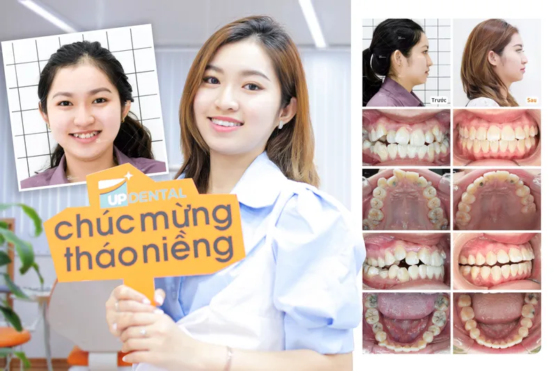 Sản phẩm bichthuy — Công Ty CP Up Dental — MST 0313476125