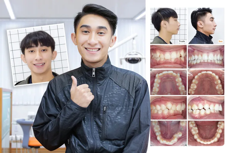 Sản phẩm dinhhuy — Công Ty CP Up Dental — MST 0313476125