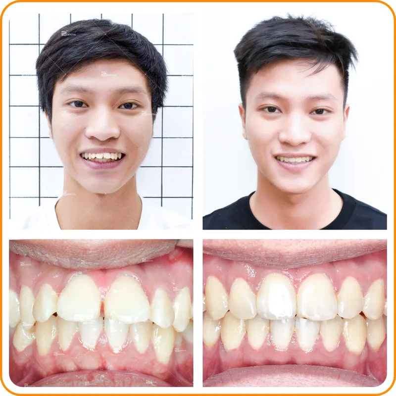 Sản phẩm ho — Công Ty CP Up Dental — MST 0313476125