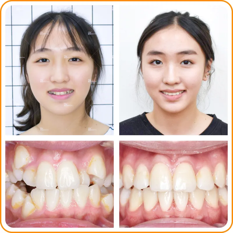 Sản phẩm lech lac — Công Ty CP Up Dental — MST 0313476125