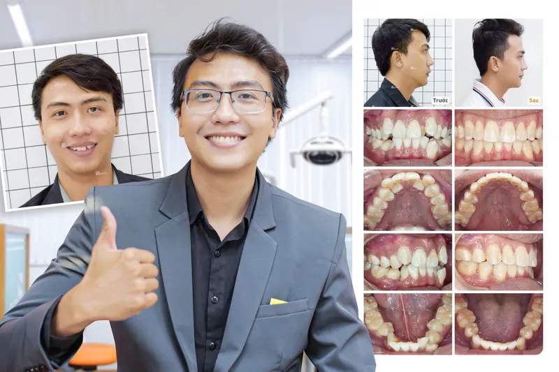 Sản phẩm minhhoang — Công Ty CP Up Dental — MST 0313476125