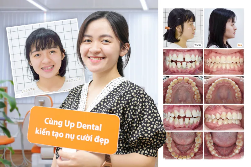 Sản phẩm myhanh — Công Ty CP Up Dental — MST 0313476125