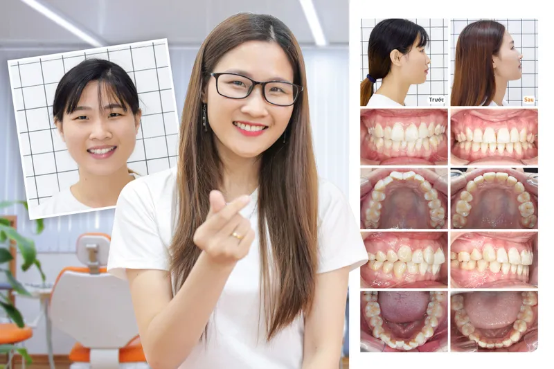 Sản phẩm ngocle — Công Ty CP Up Dental — MST 0313476125