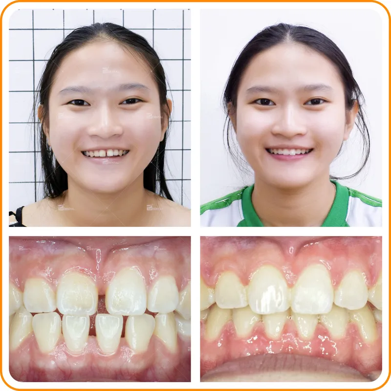 Sản phẩm thua — Công Ty CP Up Dental — MST 0313476125