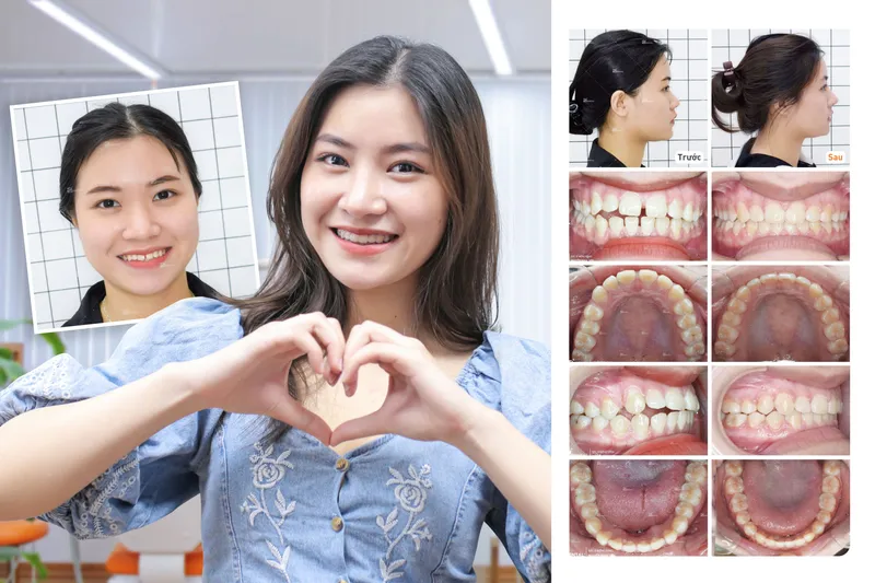 Sản phẩm thuydieu — Công Ty CP Up Dental — MST 0313476125
