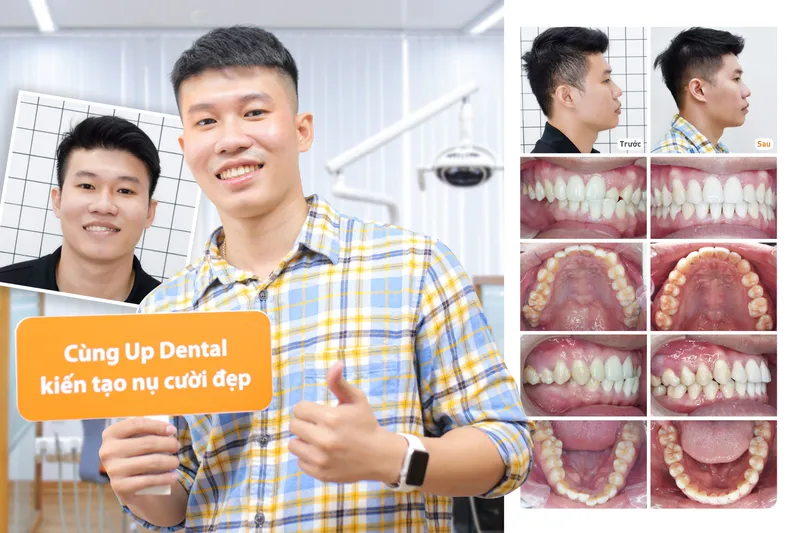Sản phẩm trungkien — Công Ty CP Up Dental — MST 0313476125