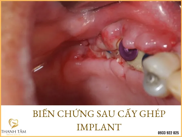 Sản phẩm bien chung sau cay ghep implant — Công Ty TNHH MTV Khánh An - Nha Khoa Thanh Tâm — MST 0315420625