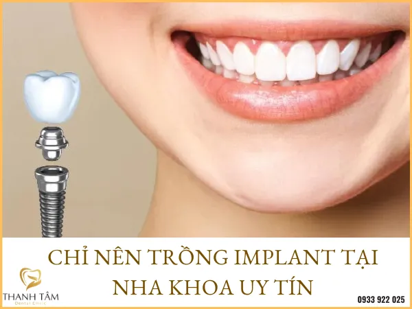 Sản phẩm dia chi lam rang implant — Công Ty TNHH MTV Khánh An - Nha Khoa Thanh Tâm — MST 0315420625