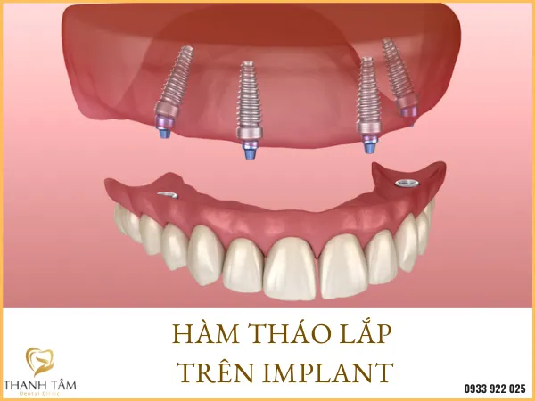 Sản phẩm ham thao lap tren implant — Công Ty TNHH MTV Khánh An - Nha Khoa Thanh Tâm — MST 0315420625