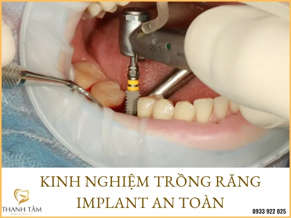 Sản phẩm kinh nghiem trong rang implant 4 — Công Ty TNHH MTV Khánh An - Nha Khoa Thanh Tâm — MST 0315420625