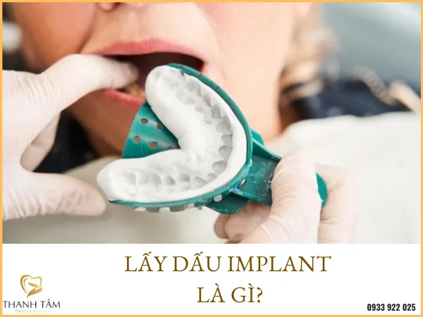 Sản phẩm lay dau implant — Công Ty TNHH MTV Khánh An - Nha Khoa Thanh Tâm — MST 0315420625