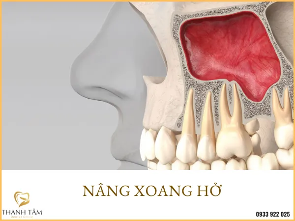 Sản phẩm nang xoang ho — Công Ty TNHH MTV Khánh An - Nha Khoa Thanh Tâm — MST 0315420625